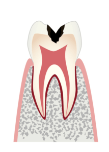 歯の内部（象牙質）まで進行したむし歯